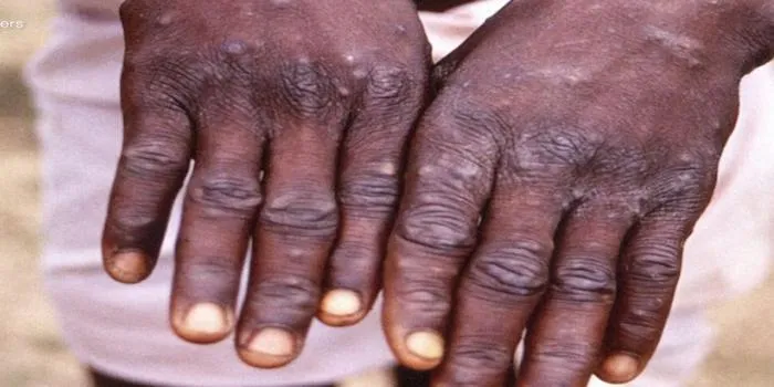 What’s in a name? Why giving monkeypox a new one is a good idea