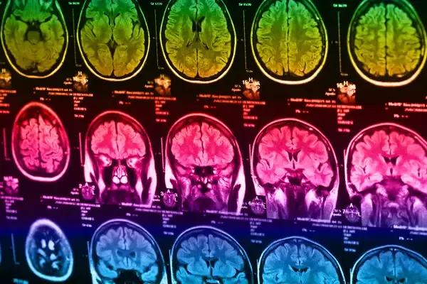 What Are the Symptoms of a Stroke?